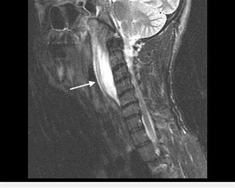 Magnetic Resonance Imaging Mri Of Soft Tissues Of The Neck Showing A