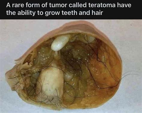 Arare Form Of Tumor Called Teratoma Have The Ability To Grow Teeth And Hair Ifunny