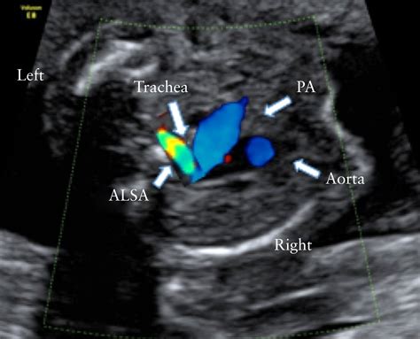 Identification And Management Of Fetal Isolated Rightsided Aortic Arch