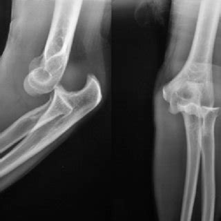 Anterior Posterior And Lateral Radiographs Of The Elbow Before