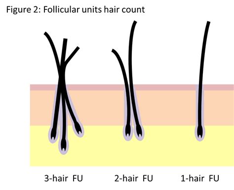 Top 48 Image Multiple Hairs In One Follicle Vn