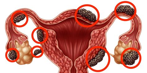 Do I Have Endometriosis And How To Manage The Pain