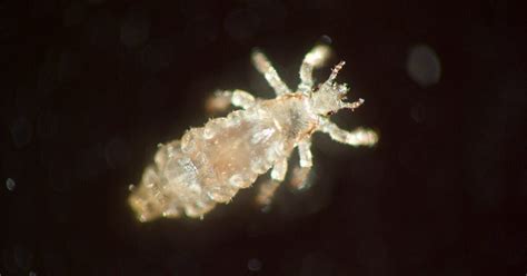 How Common Are Lice Prevalence Myths Prevention