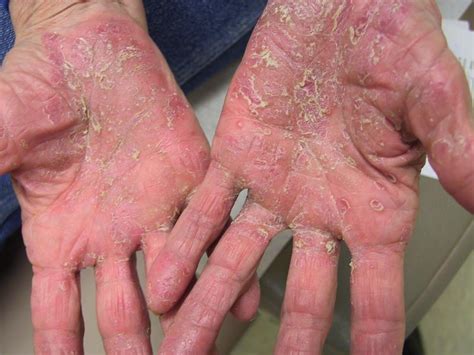 Pustular Psoriasis And Its Diagnos And Prevention