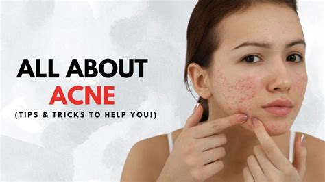 The Different Types Of Acne And How To Treat Them Youtube