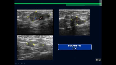 Breast Ultrasound Breast Image Sonography Mohammad Registry Anatomy
