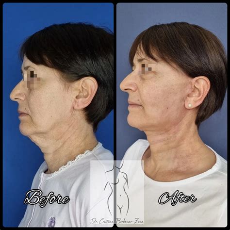Lifting Cervico Facial Chirurgie Plastica Si Estetica Chirurgie