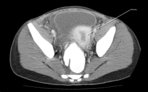 Figure 5bilateral Pyosalpinx In A Peripubescent Female With