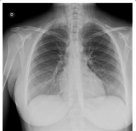 Chest X Rays Showing Pneumomediastinum And Subcutaneous Emphysema My Xxx Hot Girl
