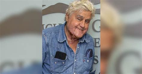 Jay Leno Shows Off Face Scars As Hes Discharged From Burn Center