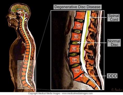 7 Best Lumbar Degenerative Disc Disease Shown On Color X Ray And Mri