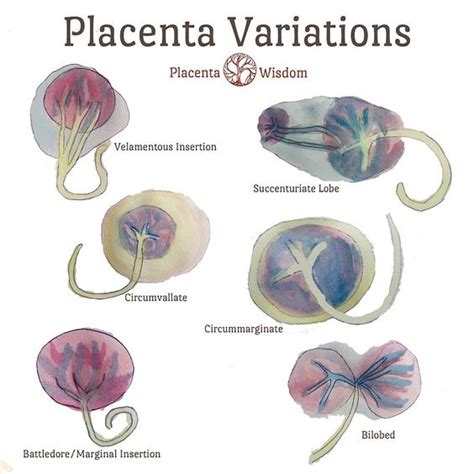 Circumvallate placenta is a placental morphological abnormality, a subtype of placenta extrachorialis in which the fetal membranes (chorion and amnion) double back on the fetal side around the edge of the placenta. Watercolour on Pinterest