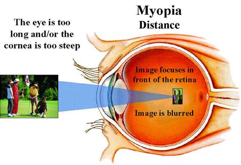 Disorders Of The Living Body Myopia