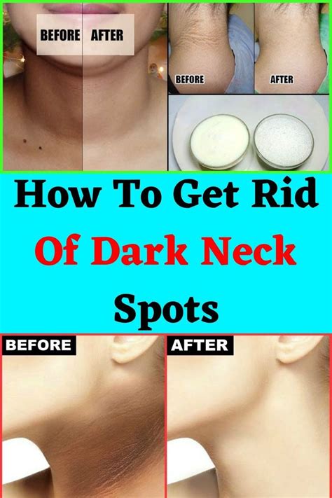 Home Remedies To Get Rid Of Dark Neck Spots In 2021 Skin Routine