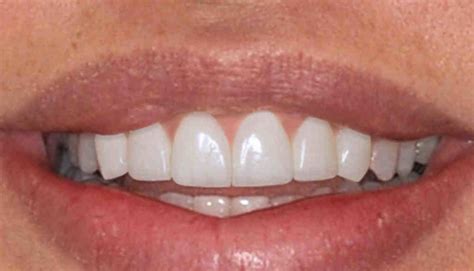 Cosmetic Dentistry To Restore Smile Dental News Network