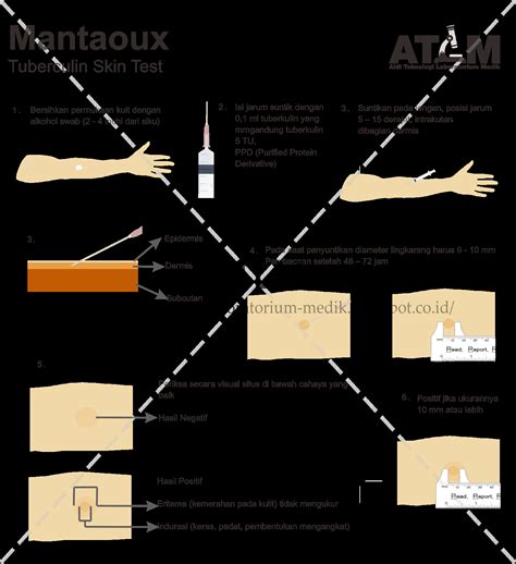 Pemeriksaan Mantoux Test Tuberculin Skin Test — Online Text Book Atlm