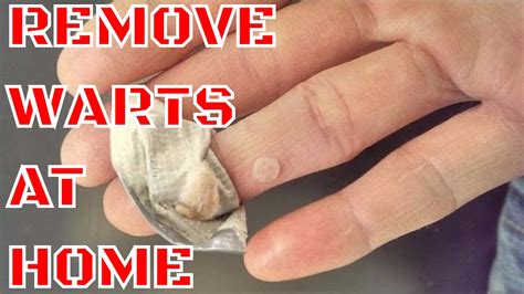 Wart Removal How To Remove Warts At Home Youtube