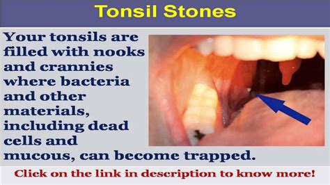 See Now Big Tonsil Stones Youtube
