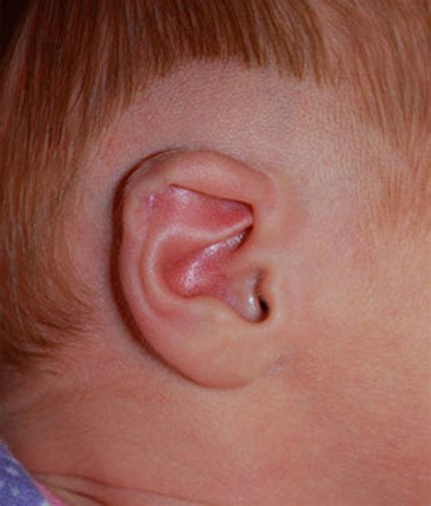 What Causes Malformed Ears