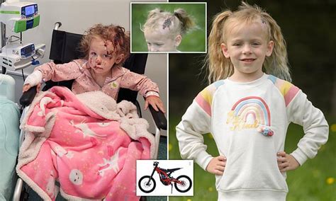 Girl 5 Is Scarred For Life After Being Hit By Electric Bike And