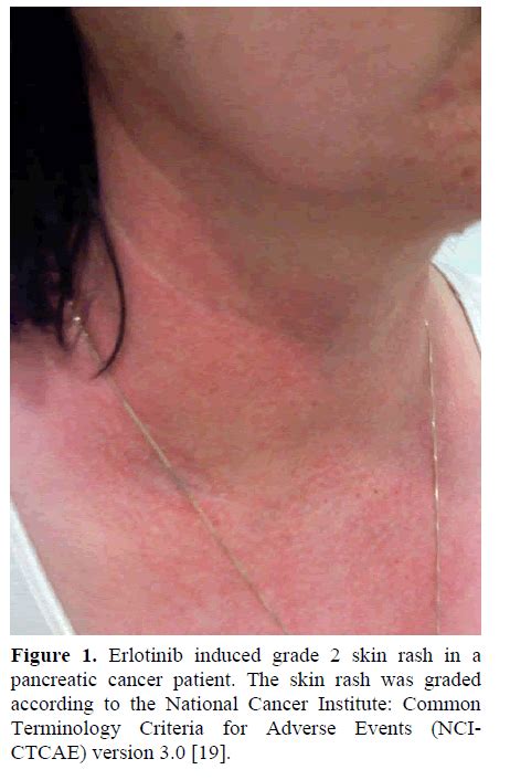 Erlotinib Induced Skin Rash Pathogenesis Clinical Significance And