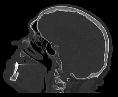 Periapical Odontogenic Abscess As Incidental Finding On Trauma Brain Ct
