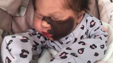Mum Of Baby Girl With Birthmark Across Face Refuses Surgery As It
