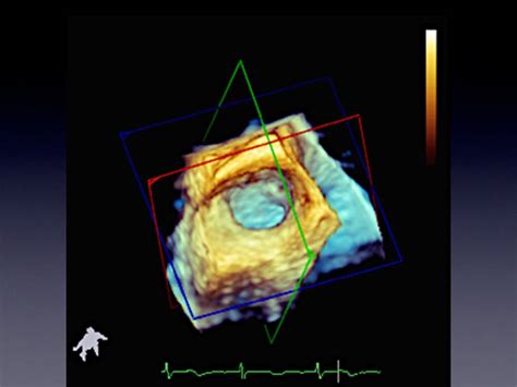 Application Of Three Dimensional Ultrasound In Left Atrial Appendage