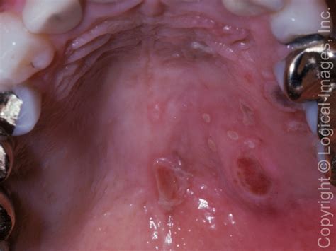 Herpes Zoster Mouth