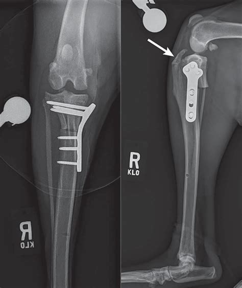 Common Tibial Plateau Leveling Osteotomy Complications Clinicians Brief