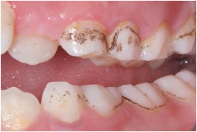 Wolff, dds, phd, professor at the new. Why Do I Have Black Stains on Teeth? | New Health Advisor