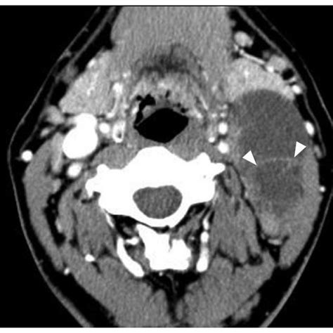 Computed Tomography Reveals A Cystic Mass With Septation Arrowheads