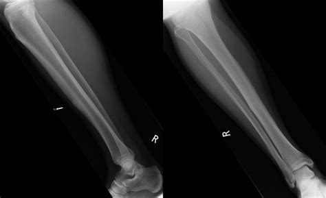 Musculoskeletal Radiology Tibial Stress Fracture