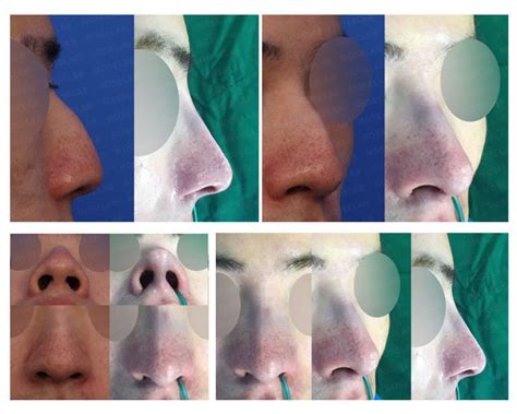 Hump Nose Deviated Nose Bulbous Nose Alar Base Reduction Nostrils Asymmetry