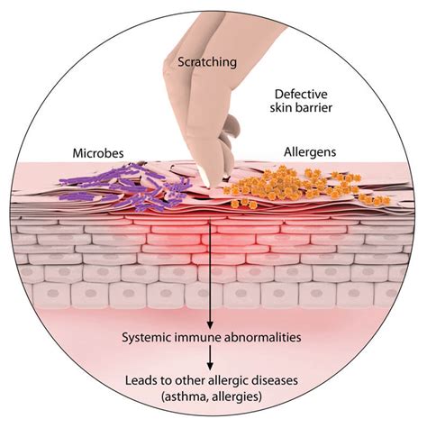 What Causes Eczema Or Atopic Dermatitis Causes Of Eczema