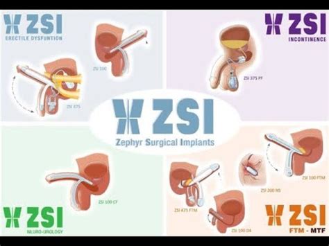 Zsi Ftm Inflatable Penile Implant For Phalloplasty Procedure Youtube