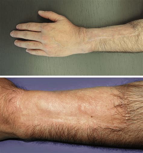 Forearm Before And After Coleman Laser Download Scientific Diagram