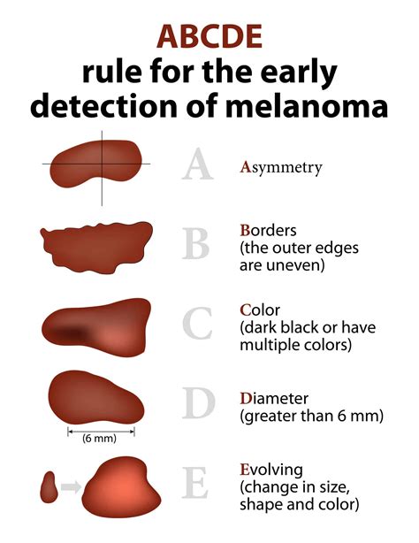 The Mole Guide What Does A Cancerous Mole Look Like Harley Medical Group