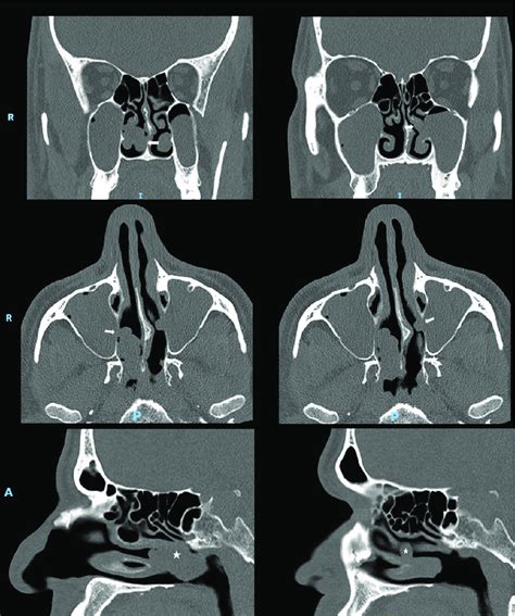 Computed Tomography Ct Scan Coronal Axial And Sagittal Views Of