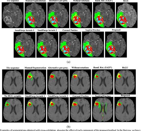 Figure 4 From Brain Tumor Segmentation Using Convolutional Neural