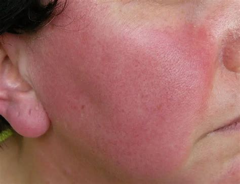 red in the face we look at rosacea and treatments that work blue hare magazine