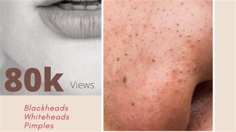 Blackheads Whiteheads Clogged Pores Prevention Youtube