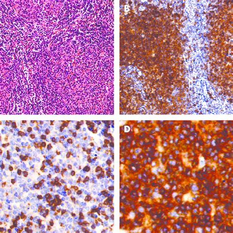 Pdf Cd5 Positive Diffuse Large B Cell Lymphoma Arising From A Cd5