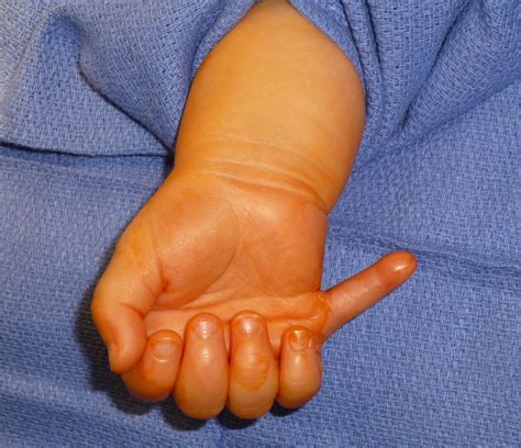 Extra Digits Congenital Hand And Arm Differences Washington
