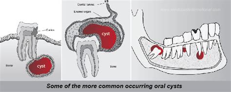Different Types Of Dental Cysts Explained