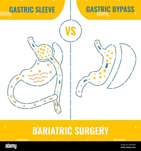 Bariatric Surgery Conceptual Illustration Stock Photo Alamy