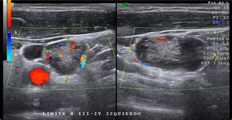 Neck Ultrasound Lymph Nodes With Heterogenous Echotexture Mixed