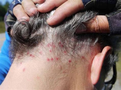 Some Lice Symptoms You Need To Be Aware Of Health Life And Recipes