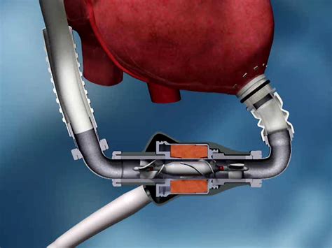 Left Ventricular Assist Devices Lvads