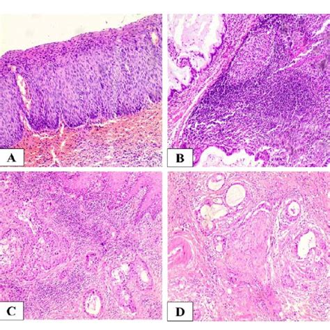 Histology Of Squamous Cell Carcinoma After Routine H And E